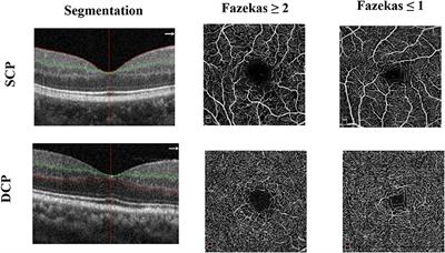 Structural and Microvascular Changes in the Macular Are Associated With Severity of White Matter Lesions